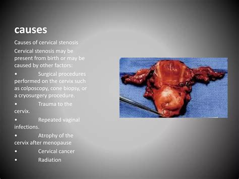 Benign diseases of the uterus and cervix | PPTX