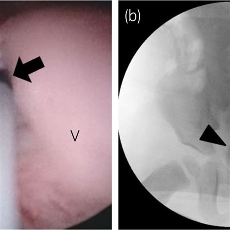 Image result for Retro Pyelogram Cystoscopy
