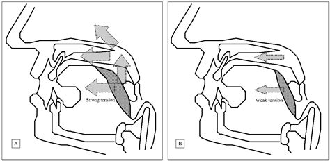 Combined Transoral Robotic Tongue Base Surgery and Palate Surgery in ...