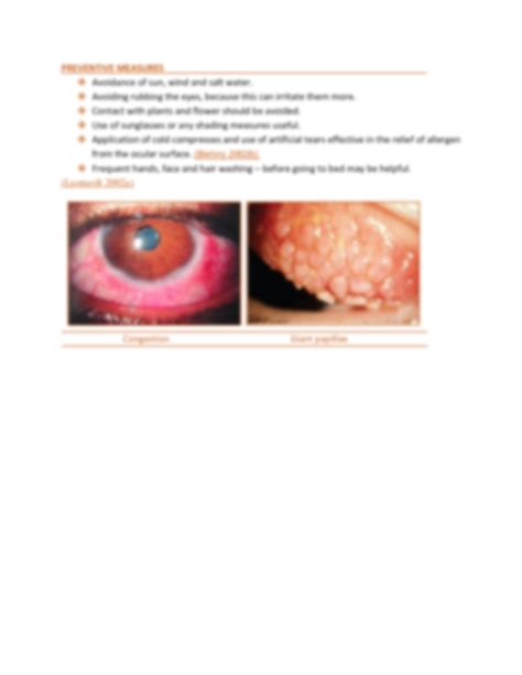 How Is Vernal Keratoconjunctivitis Treatment at Patrick Mckinnon blog
