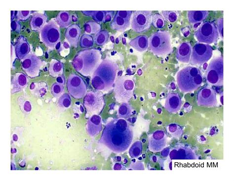FNA cytology of metastatic malignancies | PPTX