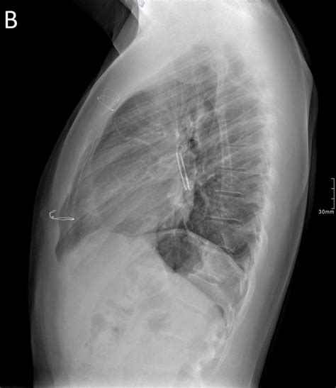 Left atrial appendage aneurysm | Eurorad