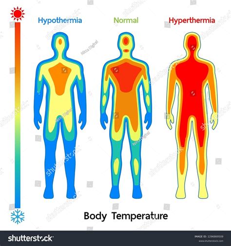 What Is A Hypothermic Body Temperature at Willard Madrigal blog