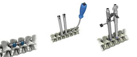 Image result for Spinal Fixation