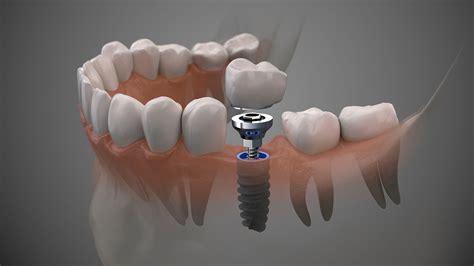 Best Dental Implants in Delhi - Smile Better, Live Better