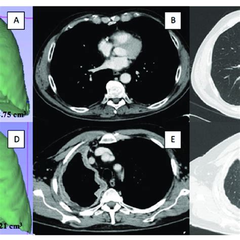 Image result for Exploratory Thoracotomy
