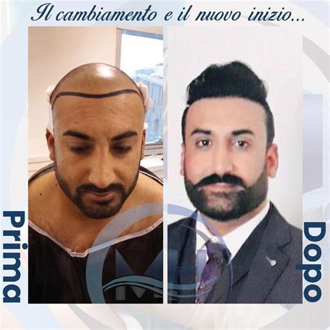 Hair transplant turkey cost 2024 miracle hair clinic – Artofit