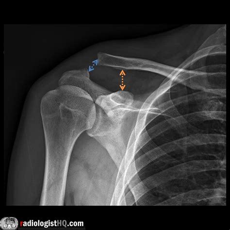 Acromioclavicular Joint X Ray
