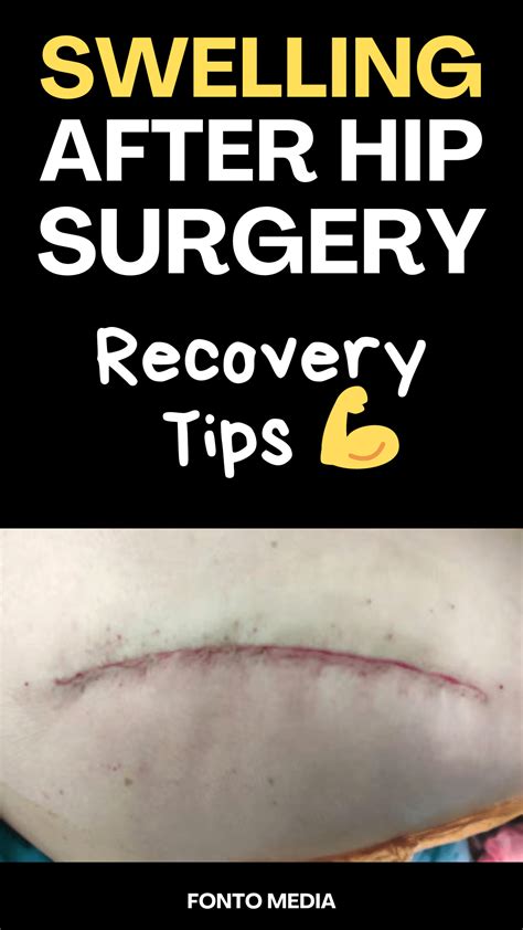 Swelling after hip replacement cause recovery time tips – Artofit