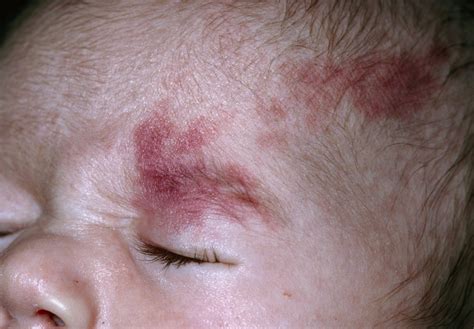 Quantitative EEG Prognostic for Sturge-Weber Syndrome in Infants With ...