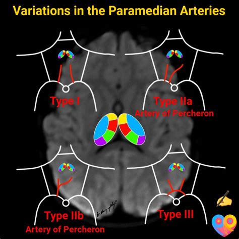 Paramedian Artery
