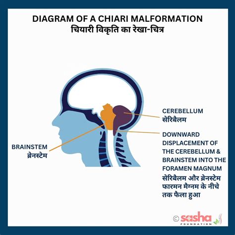 What is Chiari Malformation? How does it affect SB people?