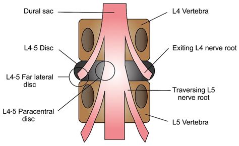 Selective Nerve Root Block in Treatment of Lumbar Radiculopathy: A ...