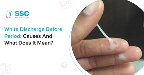 White Discharge Before Period: Causes and What Does It Mean?