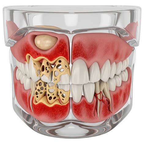 How Osteomyelitis Affects the Jaw Bone and Healing - UNIDENTAL