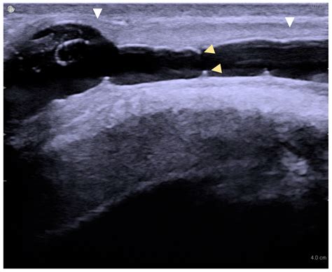 Seeing the Stricture Clearly: Independent Determinants of ...