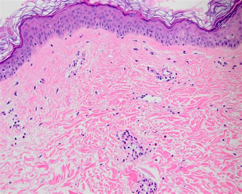 Pathology Outlines - Dermal hypersensitivity reaction