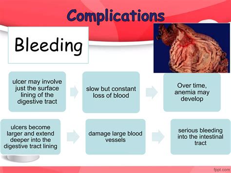 Peptic ulcer pharmaology | PPTX