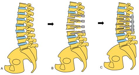 New Spinal Shortening Technique for Tethered Cord Syndrome: A Technical Note