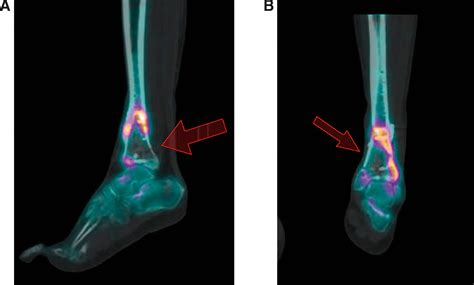 Complete Reduction for Pilon Fracture Can Make Complete Failure