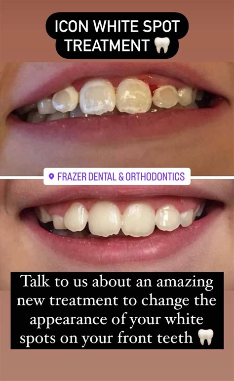 White spots on your teeth? Introducing ICON white spot treatment ...