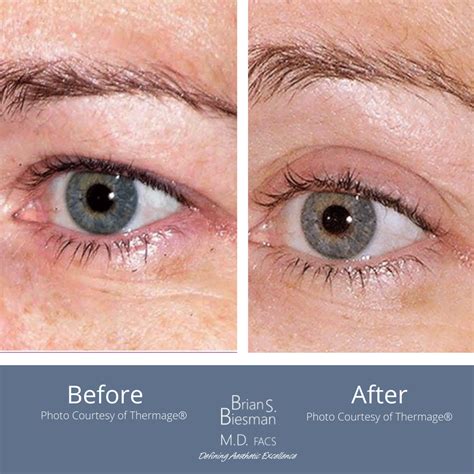 Eyelid surgery before after – Artofit