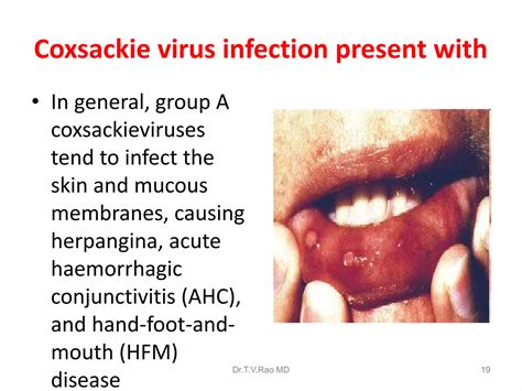 Coxsackievirus (2).ppt