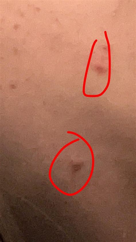 Image result for Explosive Back Cysts