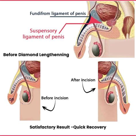 Suspensory Ligament Before And After