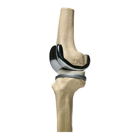 Prótesis de rodilla - Dr. Héctor González