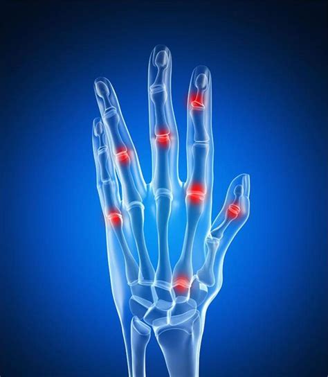 手指关节疼痛的原因 手指关节痛的原因有哪些_第二人生