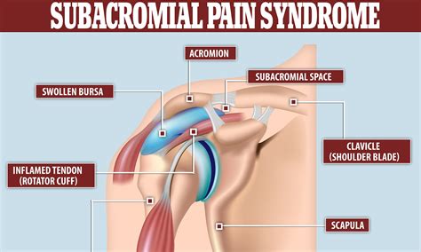 Rotator Cuff Related Shoulder Pain Nhs at Joel Sherwin blog