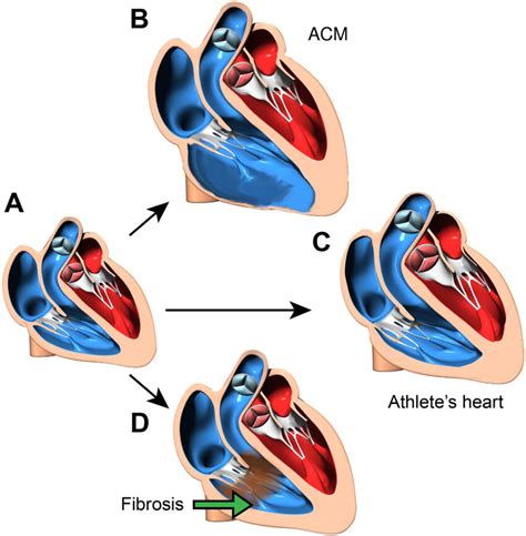 Image result for Heart Development Disorders