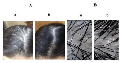 Formulation of Sodium Valproate Nanospanlastics as a Promising Approach ...