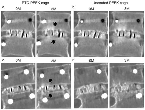 Surface Modification Techniques for Polyetheretherketone as Spinal ...