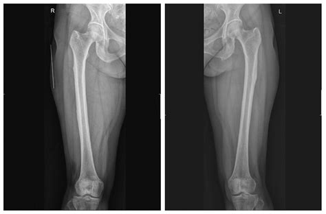 Bilateral Atypical Femoral Fractures after Bisphosphonate Treatment for ...