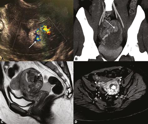 SciELO Brasil - Subinvolution of the placental site associated with ...
