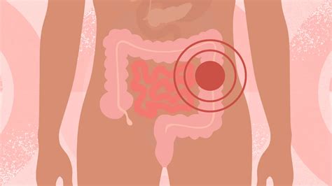 Ulcerative Colitis Surgery 的图像结果