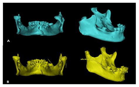 Reliability of a Trapezium Miniplate with Endoscope-Assisted Internal ...
