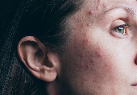 Image result for Exploding Pimples