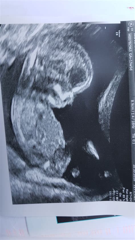 13 Week Ultrasound Boy