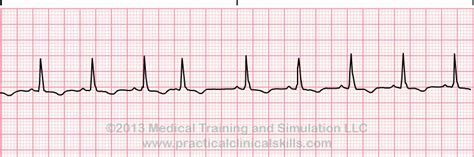 Image result for Pacemaker Programming