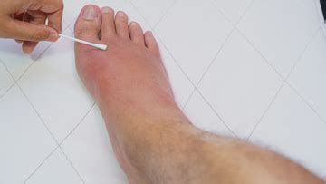 General Pediatrics : Elephantiasis : Elephantiasis Patient Education ...