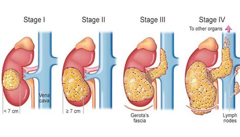 Kidney cancer Diagnosis & Treatment from Top cancer Hospital in Delhi