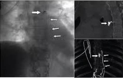 Treatment with intranodal lymphangiography, ethiodized oil safe for ...