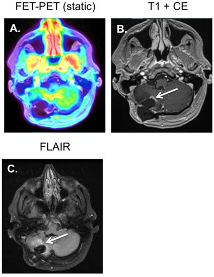 Diagnostics | Special Issue : Brain Tumor Imaging