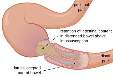 Image result for Intussusception Symptoms