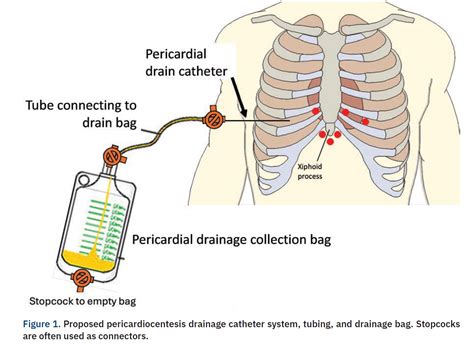 Conversations in Cardiology: Management of Pericardial Drains