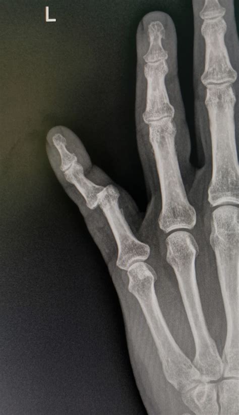 Image result for Finger Dislocation Reduction