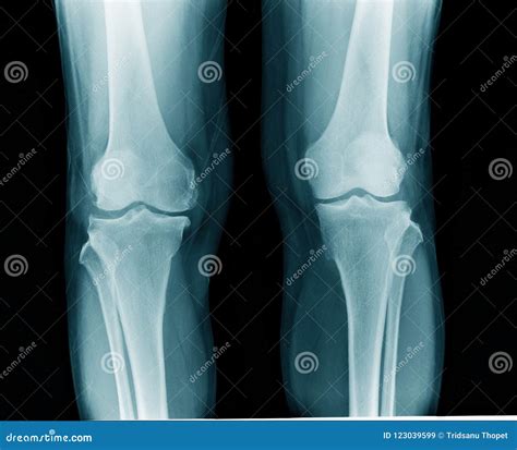 Artritis De La Rodilla De La Radiografía Imagen de archivo - Imagen de ...